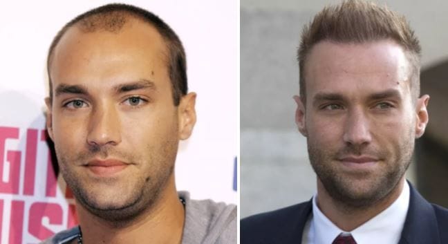 Celebrity with hair transplant before and after