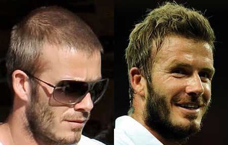David beckham celebrities with hair transplants