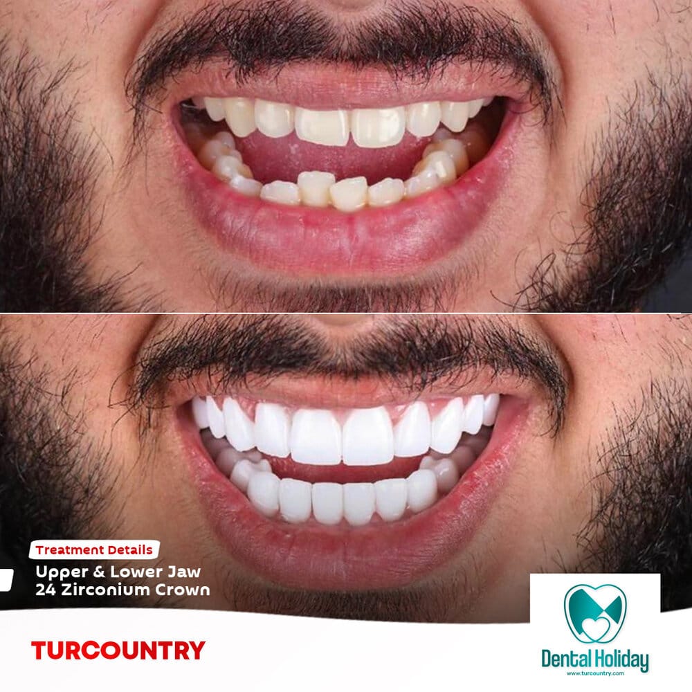 Zirconium crown before after turkey