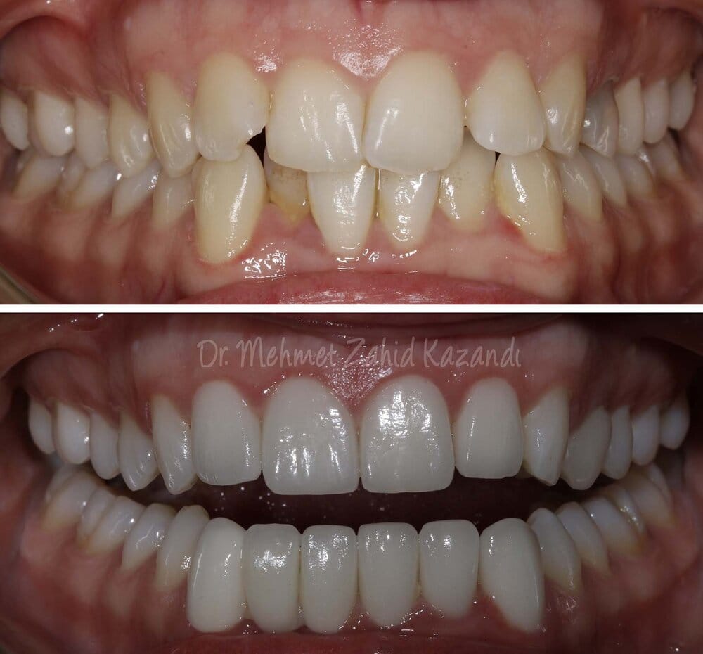 Veneers turkey 170b4