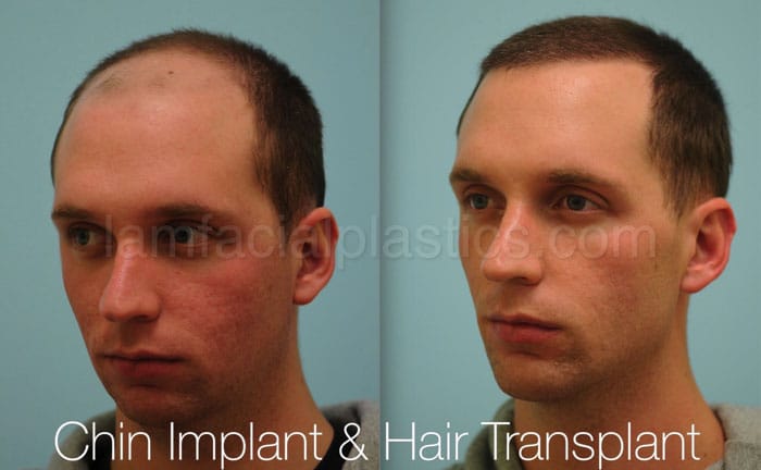Chin augmentation bxa 17