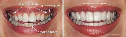 Dental Veneers to Widen the Smile