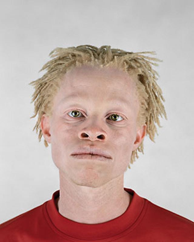 Blackalbino