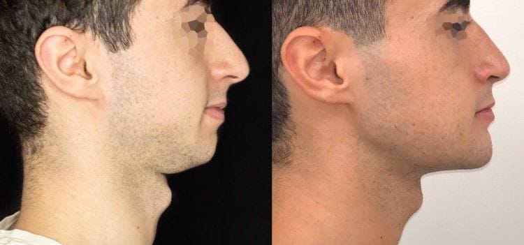 Lord madness before and after side profile