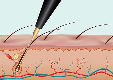Electrolysispic 1 Electrolysispic 1