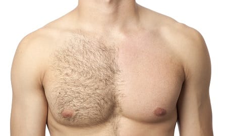 Electrolysis Hair Removal Electrolysis Hair Removal