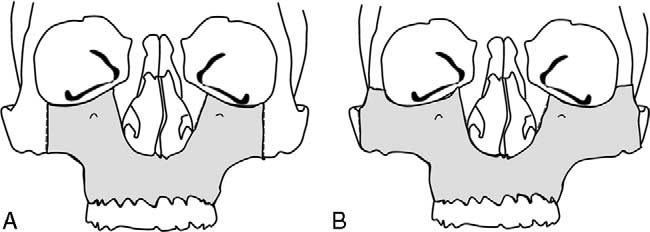 Composite picture of osteotomy designs for which the degloving approach was used A
