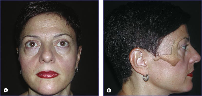 Infraorbital rim  Plastic Surgery Key  f08 03 9780323624763