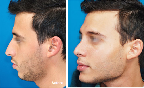 Bimax rhino genio implants