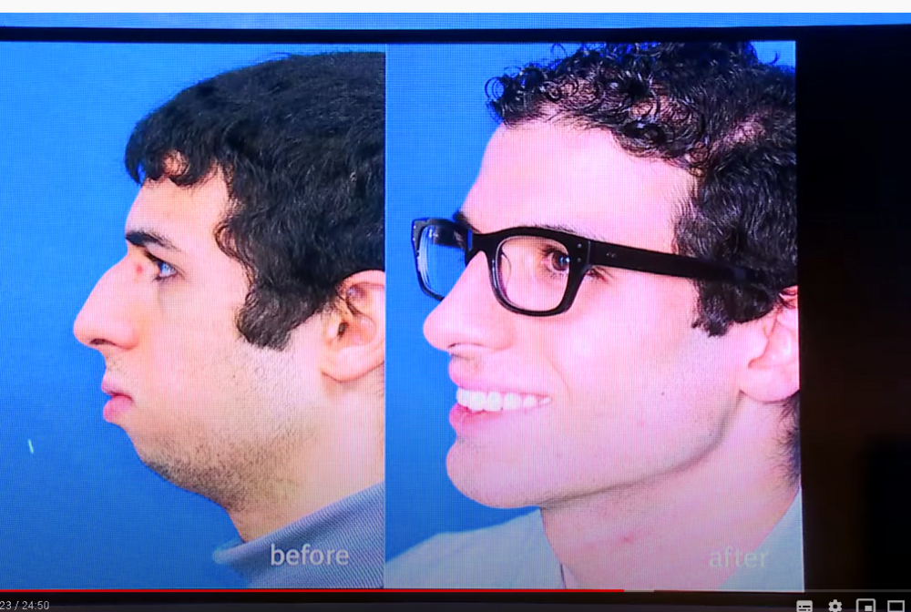 Bimax rhino genio implants