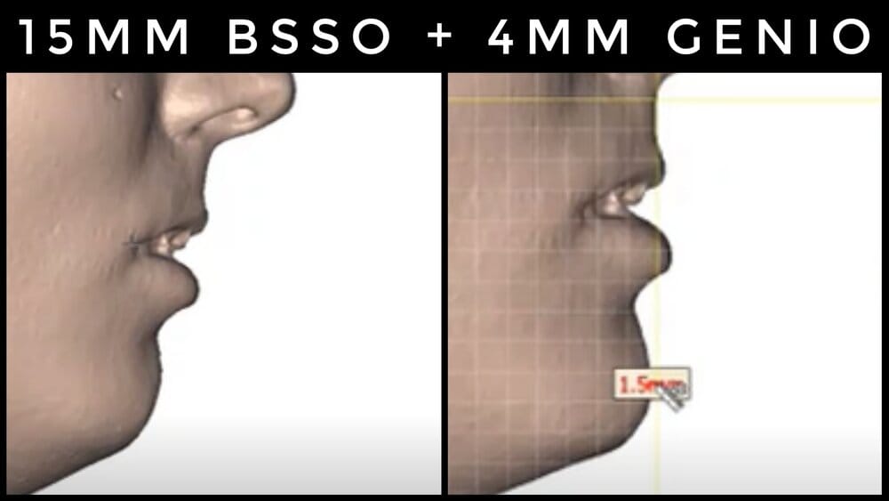 You should always get more Double the genio