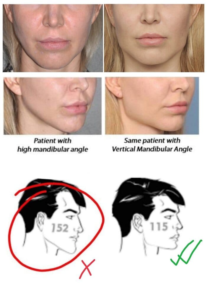 Ramus osteotomy  Maxillary impaction