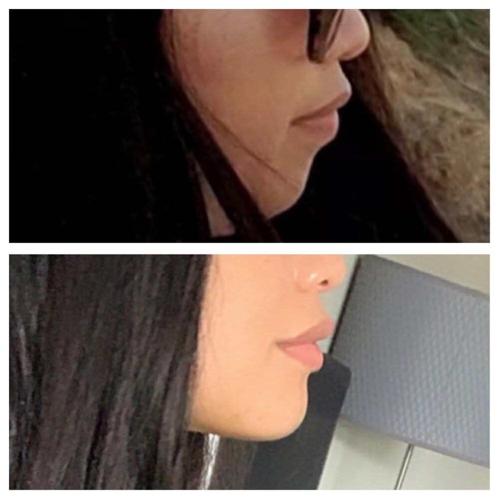 Chin implants