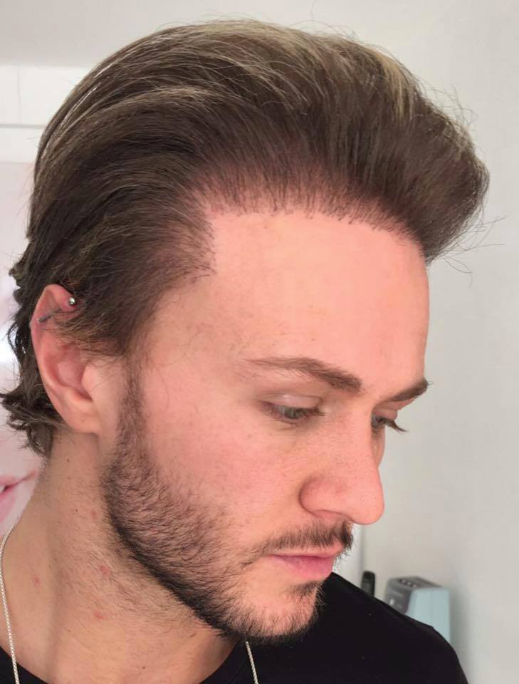 Kyle Christie bad hair transplant