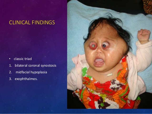 Craniosynostosis 24 638