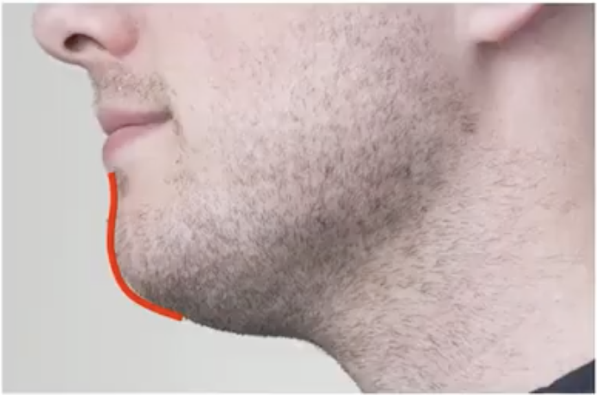 Flat chin