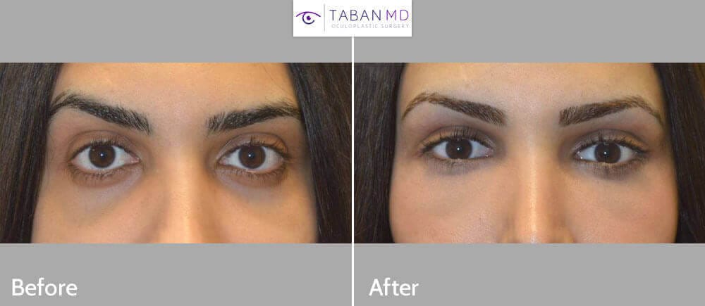 Shayan before and after 1a mn