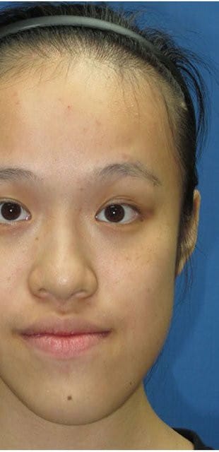 Left This 18 years old female patient with prognathism facial asymmetry and long face Q640 22