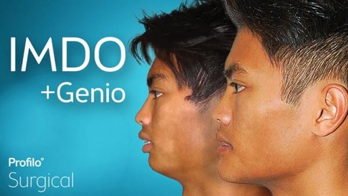 Imdo genioplasty chin surgery profilo surgical 3
