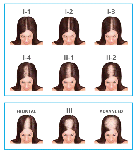 Female baldness image