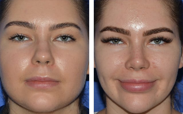 Rhinoplasty p04 02