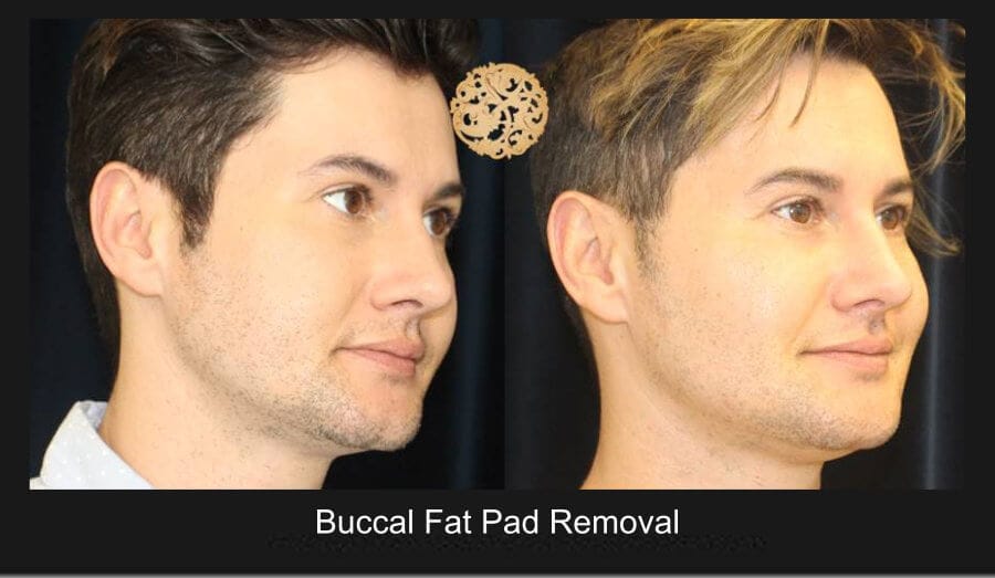 Buc fat pad removal a3
