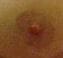 Nipple