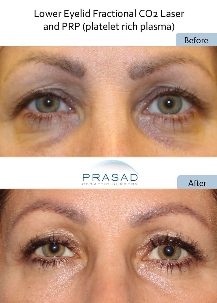 Lower Eyelid Fractional CO2 Laser and PRP