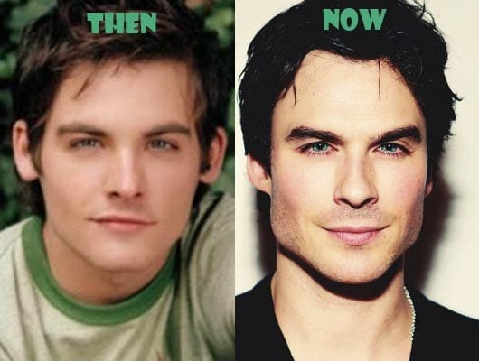 Ian Somerhalder Plastic Surgery 1