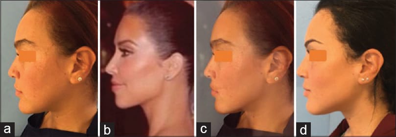 AnnMaxillofacSurg 2016 6 2 287 200325 f1