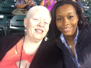 Albinism3 d5cf3920a05c943a059451530b650059c4450fdf