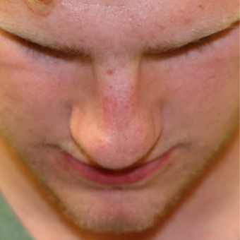 Wow a very Good and subtle Rhinoplasty | Looksmax.org - Men's Self ...