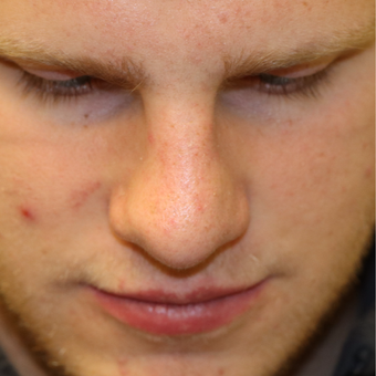 Wow a very Good and subtle Rhinoplasty | Looksmax.org - Men's Self ...