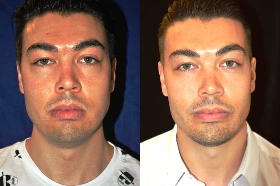 Buccal fat excision and square jaw implant front view 1