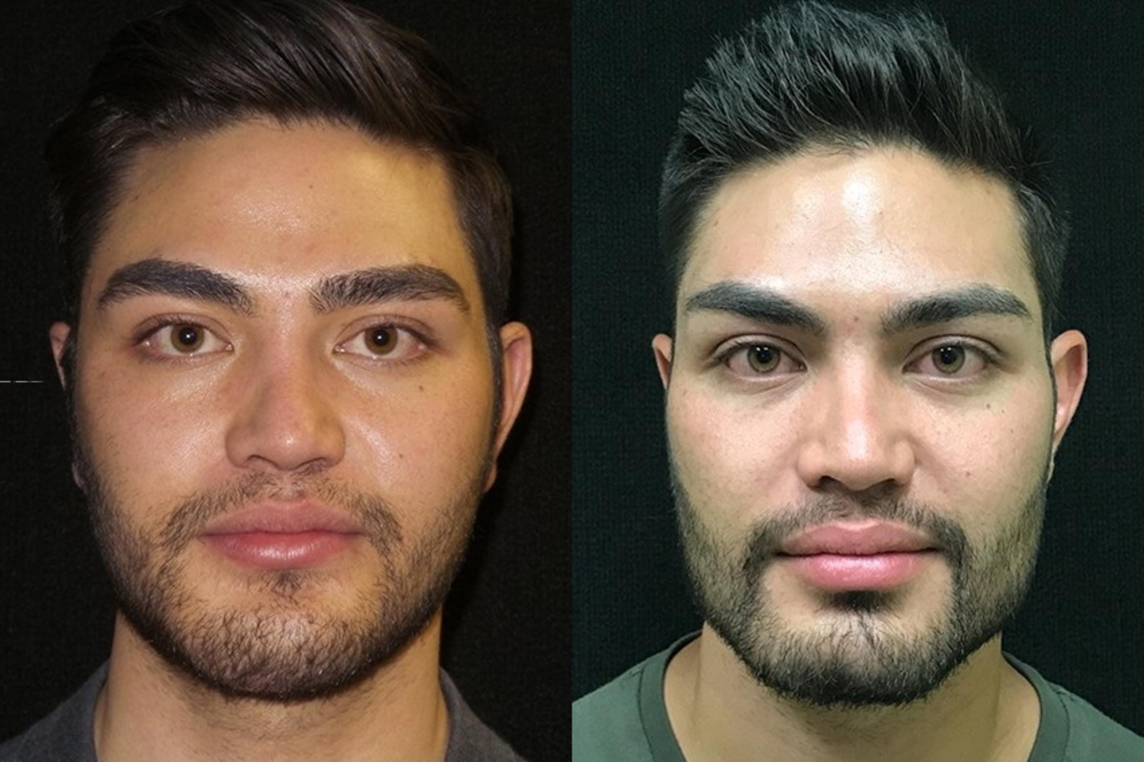 Chin augmentation buccal fat removal 66 front detail