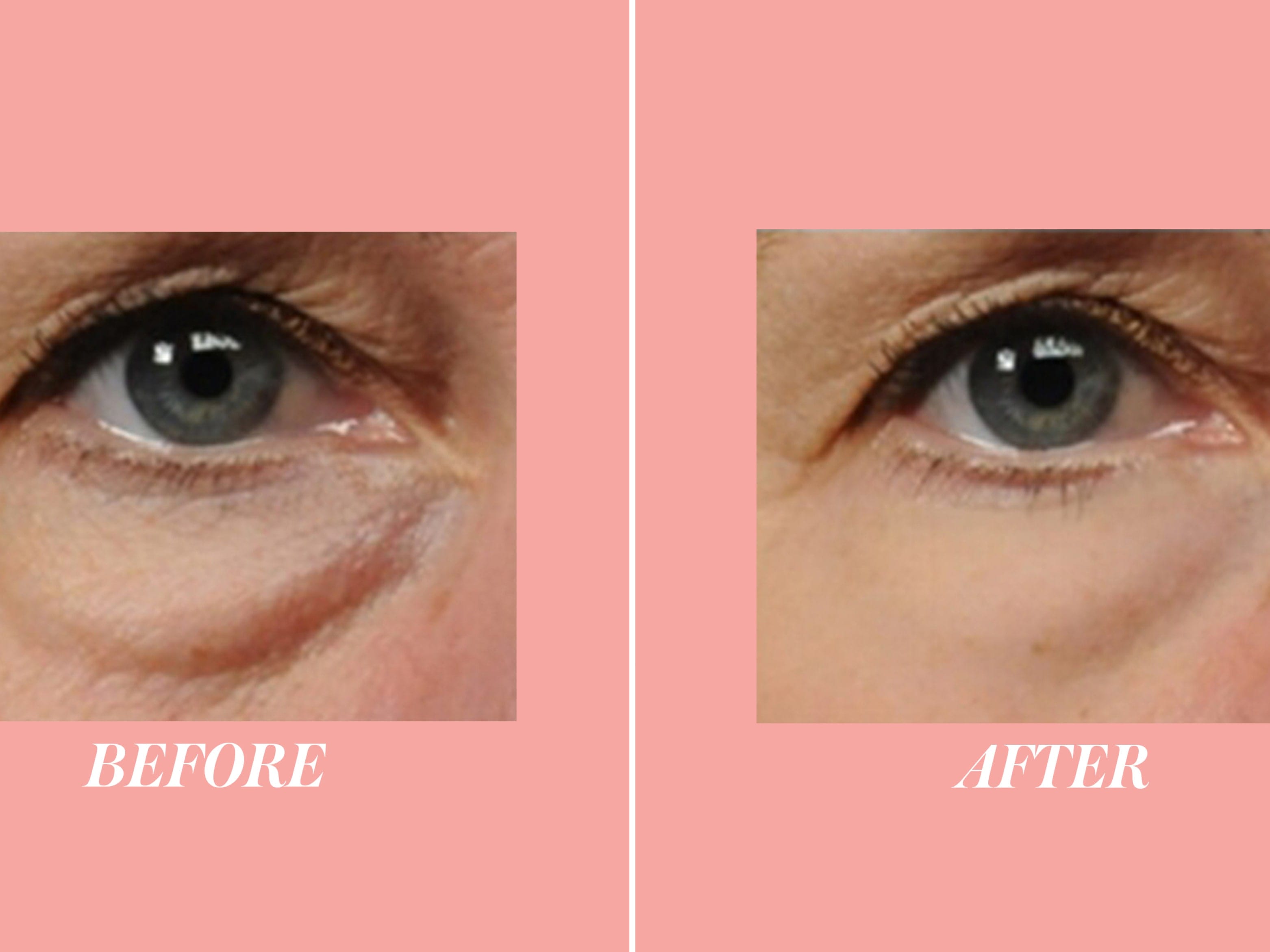 Before after eye bags