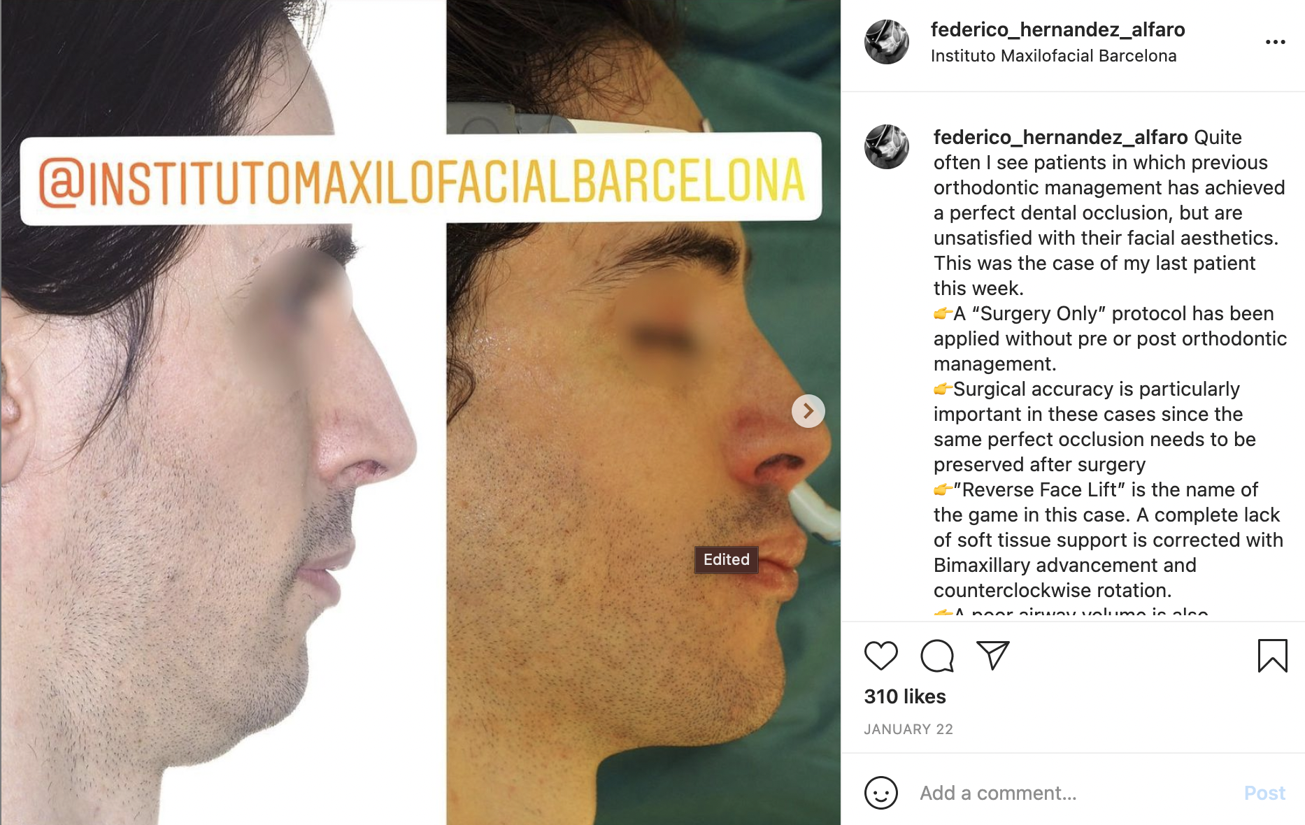 Surgery only