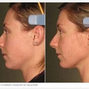 Ultherapy