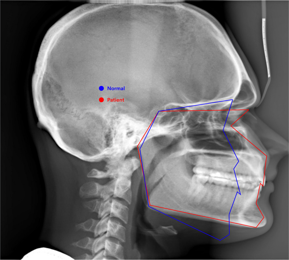 Normal  Patient