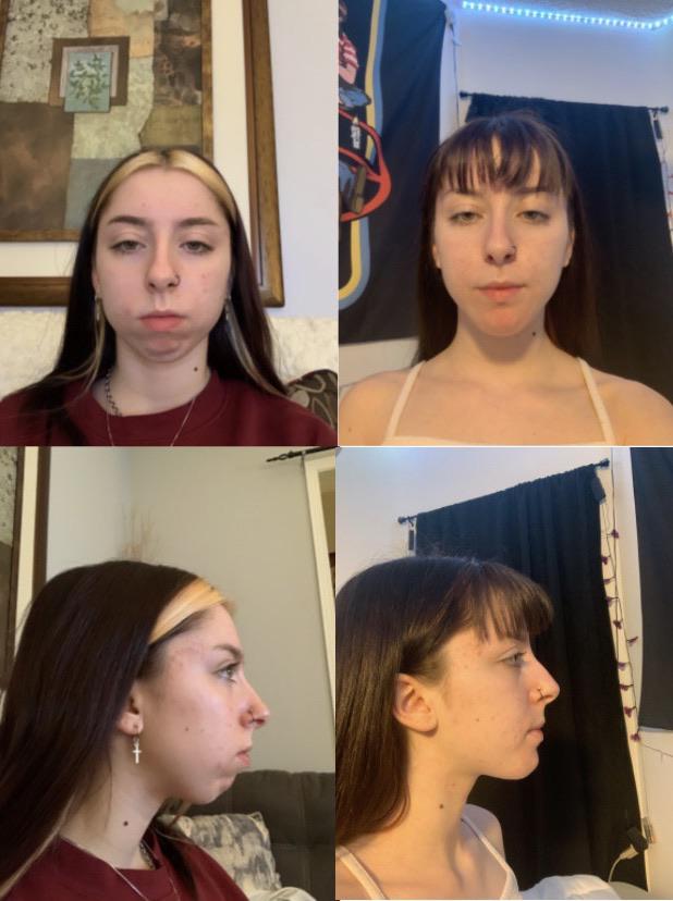 Funny 10mm genioplasty uvgwfgucr9v41