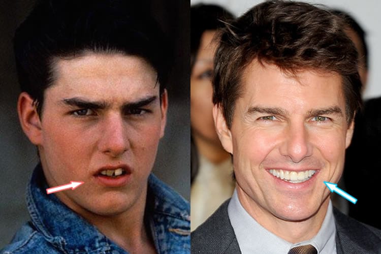Tom cruise teeth