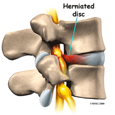 Herniateddisc