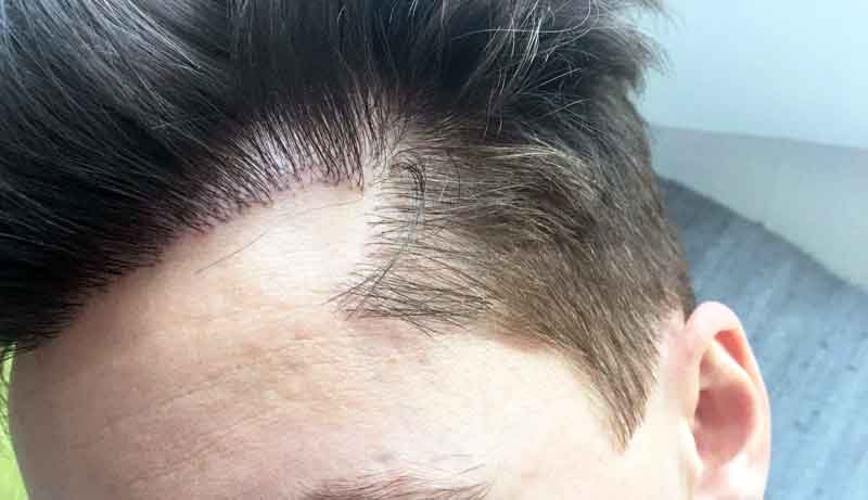 Bad hair transplant hairline