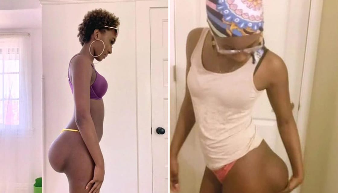 Woman botched bum implants E 1120