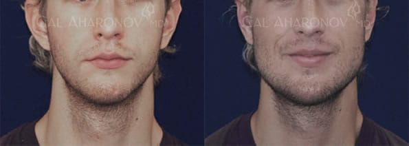 Jaw implants angle mandible implants jaw augmentation 01 fs