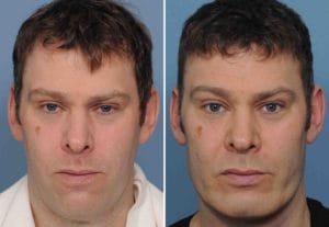 Male Custom Infraorbital Malar and Jawline Implant results front view Dr Barry Eppley Indianap