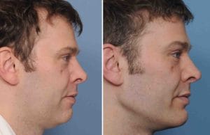 Male Custom Infraorbital Malar and Jawline Implant results side view Dr Barry Eppley Indianapo