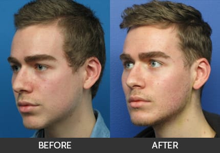 Cheek augmentation 05 thumbs