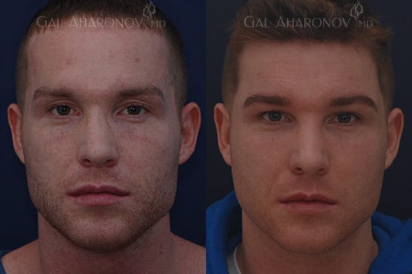 Male facial fillers facial volume loss 02