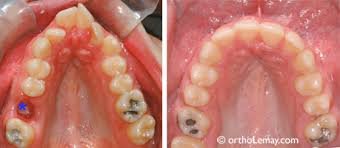 Maxilla v vs u